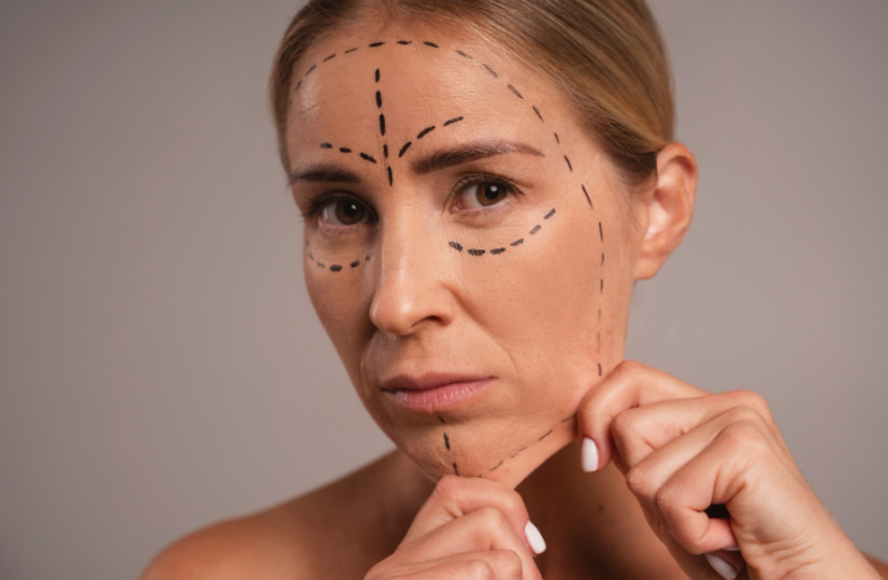 Gangnam Thread Lift Duration: Can it Last Over a Year? 사진 2