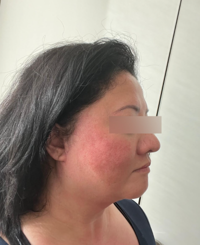 Facelift: Will I regret getting it too early? 사진 8