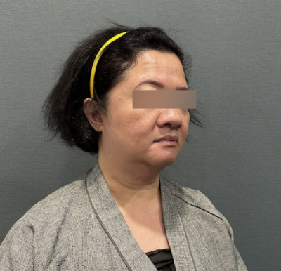 Facelift: Will I regret getting it too early? 사진 7