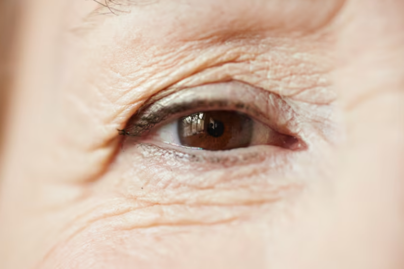 Middle-Aged Upper Blepharoplasty: Where Did the Change in Eyelid Shape Begin? 사진 2