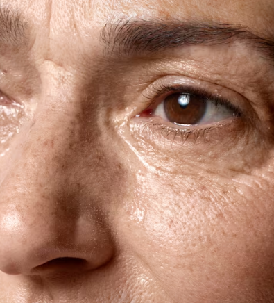 Why 60s Lower Blepharoplasty May Differ from 50s Surgery 사진 2