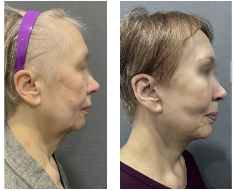 Gangnam Plastic Surgery: How Long Do Facelift Effects Last? 사진 9