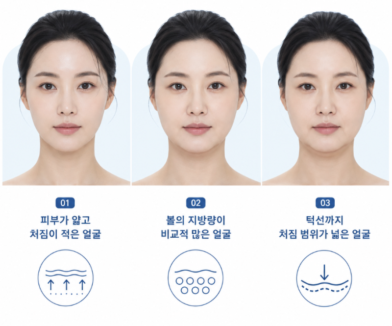Facial Thread Lift Cost: Does More Threads Always Mean Better Results? 사진 5