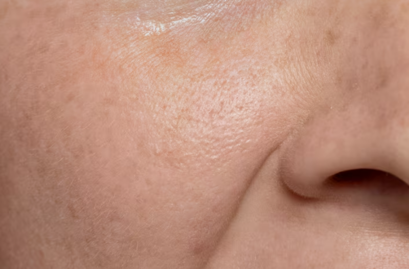 Facelift Surgery: At What Age Should You Consider It? Why Even Those in Their 20s and 30s Might Need It 사진 3