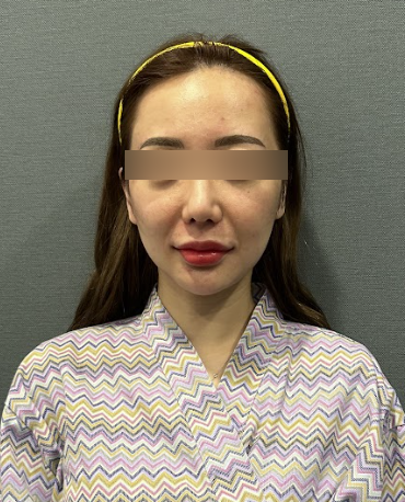 Thread Lift Pain: Is It Bearable? What to Know Before the Procedure 사진 9