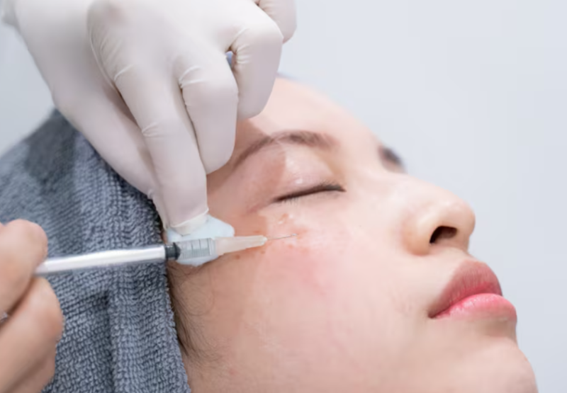 Thread Lift Pain: Is It Bearable? What to Know Before the Procedure 사진 2