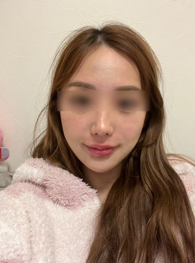 Thread Lift Pain: Is It Bearable? What to Know Before the Procedure 사진 10