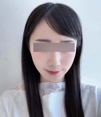 강남 실리프팅잘하는곳, 얼굴이 처져 보인다면 실 개수보다 중요한 것은? 사진 8