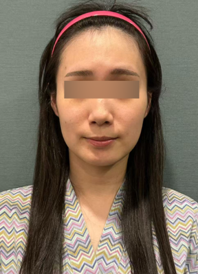 강남 실리프팅잘하는곳, 얼굴이 처져 보인다면 실 개수보다 중요한 것은? 사진 7