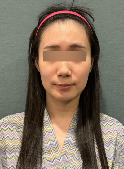 Efek Thread Lift, Seberapa Banyak Perubahan pada Pipi Kendur dan Garis Rahang yang Rusak? 사진 5