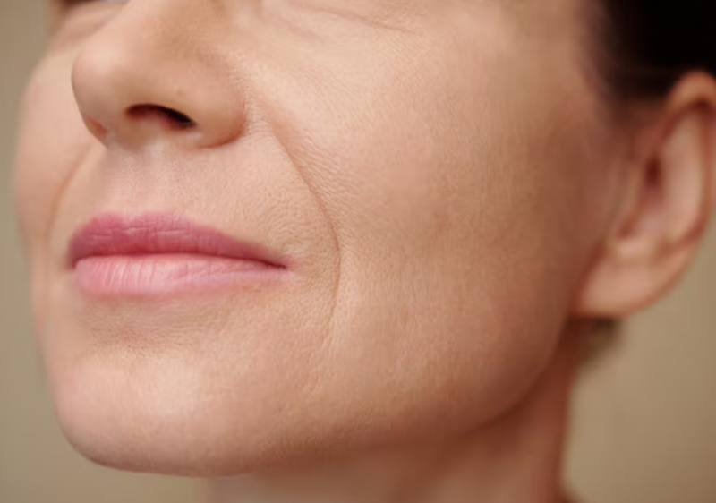 Thread Lift for Nasolabial Folds: How Much Improvement Can Be Expected for Deepened Lines? 사진 2