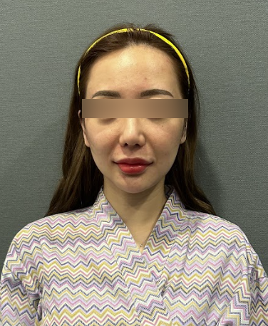 Thread Lift for Nasolabial Folds: How Much Improvement Can Be Expected for Deepened Lines? 사진 7