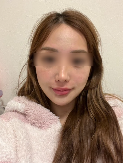 Thread Lift for Nasolabial Folds: How Much Improvement Can Be Expected for Deepened Lines? 사진 8