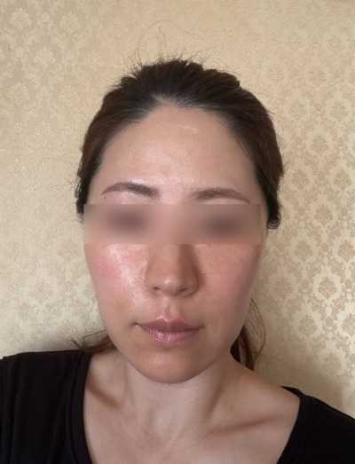 땅콩형얼굴 실리프팅, 꺼진 볼만 채우면 해결될까요? 사진 8