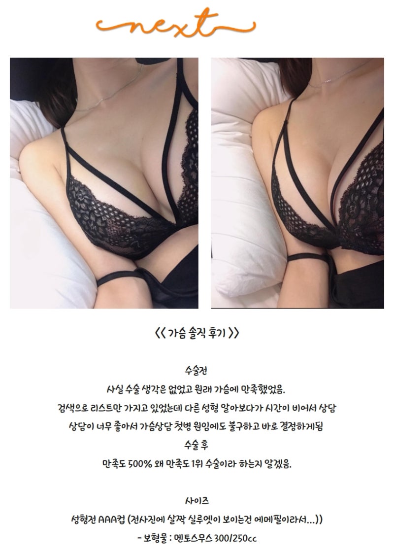NEXT Plastic Surgery_BarbieTalk_Breast Augmentation Review_Mentor Smooth