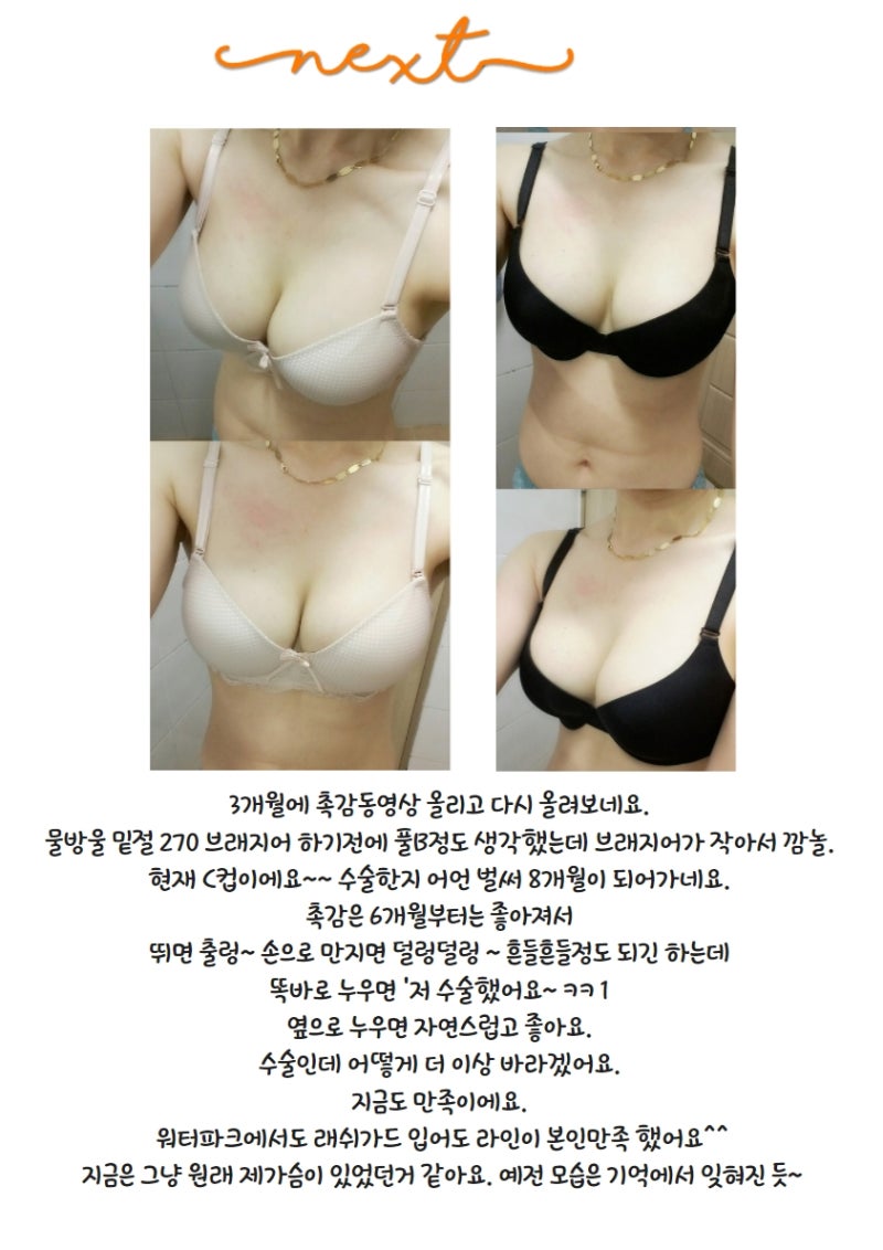 NEXT Plastic Surgery_Ulasan Nyata Operasi Pembesaran Payudara Babitalk