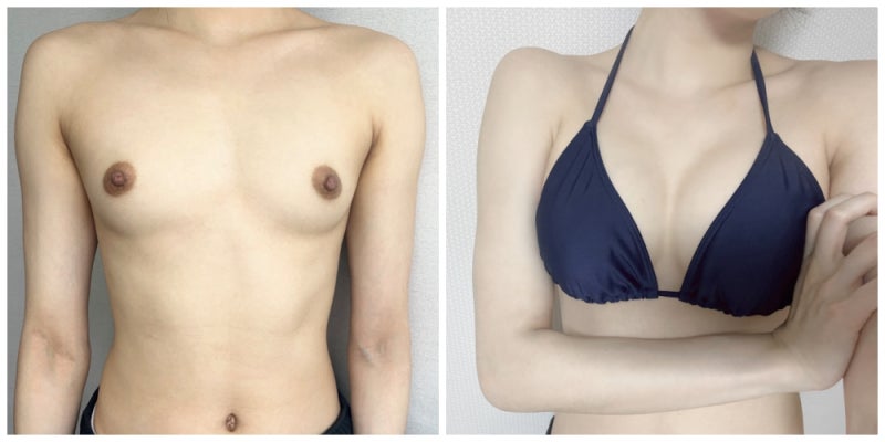 Motiva 325, 330cc: 5-Month Post-Op Review 사진 3