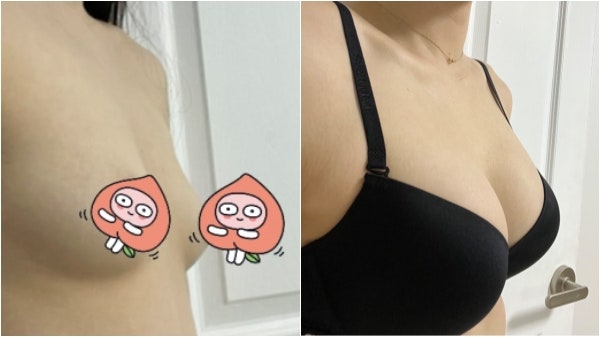 3-Month Post-Breast Augmentation Review