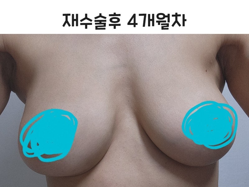 Đánh giá phẫu thuật lại sau khi túi nước muối bị vỡ - Phẫu thuật lại ngực 사진 3