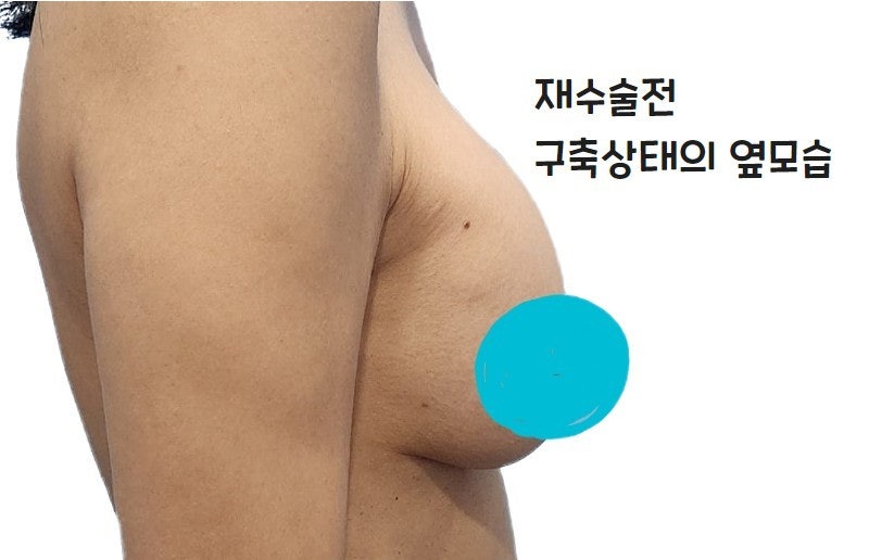 Đánh giá phẫu thuật lại sau khi túi nước muối bị vỡ - Phẫu thuật lại ngực