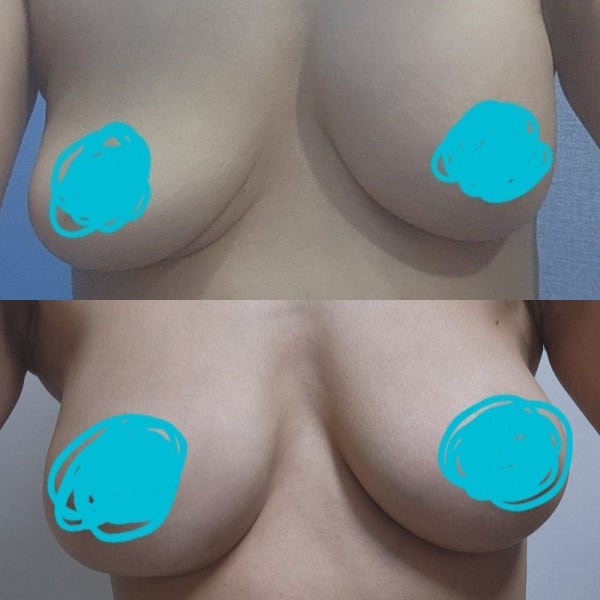 Đánh giá phẫu thuật lại sau khi túi nước muối bị vỡ - Phẫu thuật lại ngực 사진 5