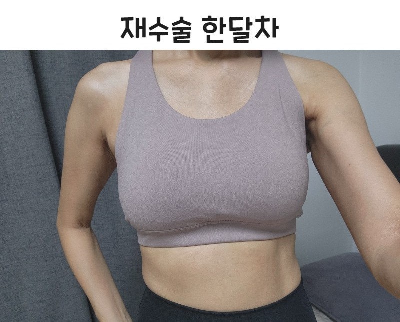 Đánh giá phẫu thuật lại sau khi túi nước muối bị vỡ - Phẫu thuật lại ngực 사진 4