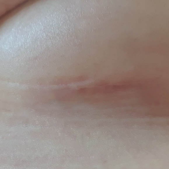 5-Month Update: Inframammary Incision Breast Augmentation 사진 2