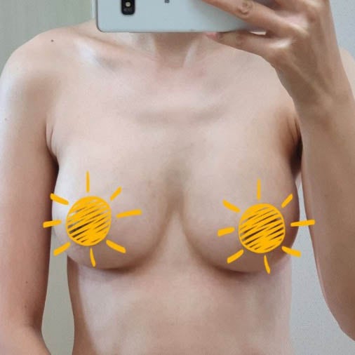5-Month Update: Inframammary Incision Breast Augmentation