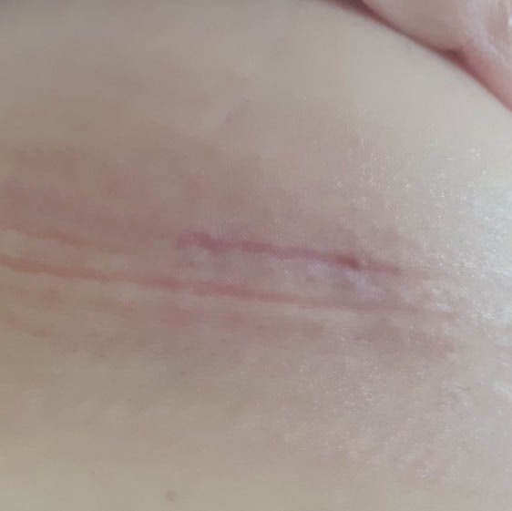 5-Month Update: Inframammary Incision Breast Augmentation