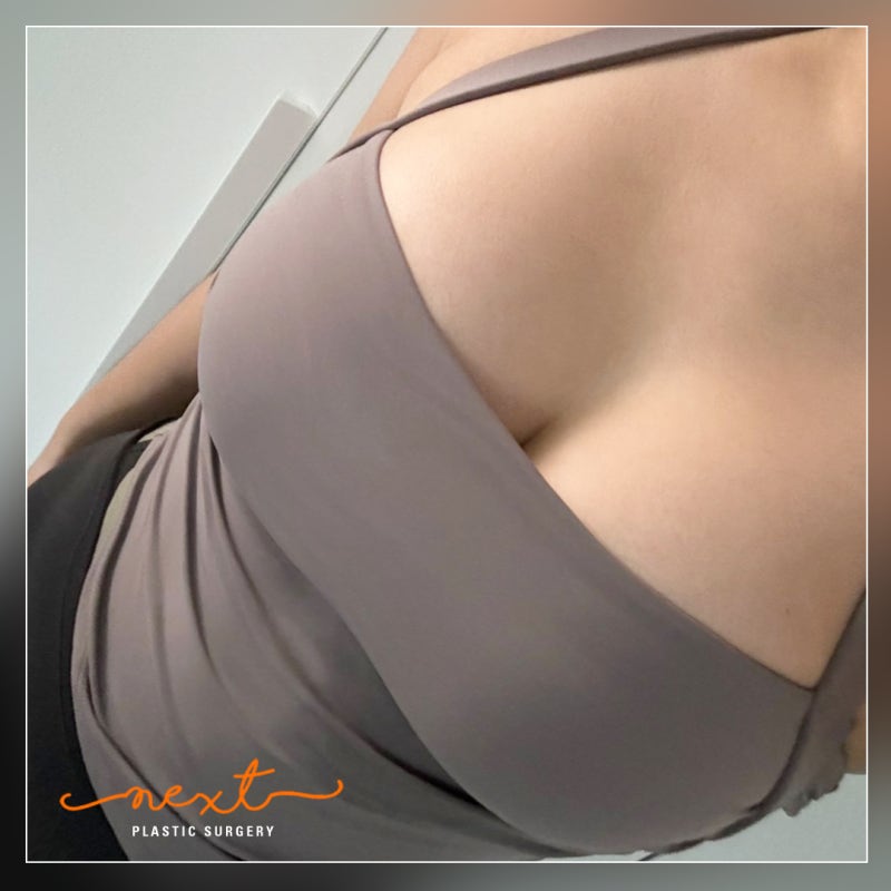 Breast Augmentation Incision Sites: Armpit or Inframammary Fold? 사진 4