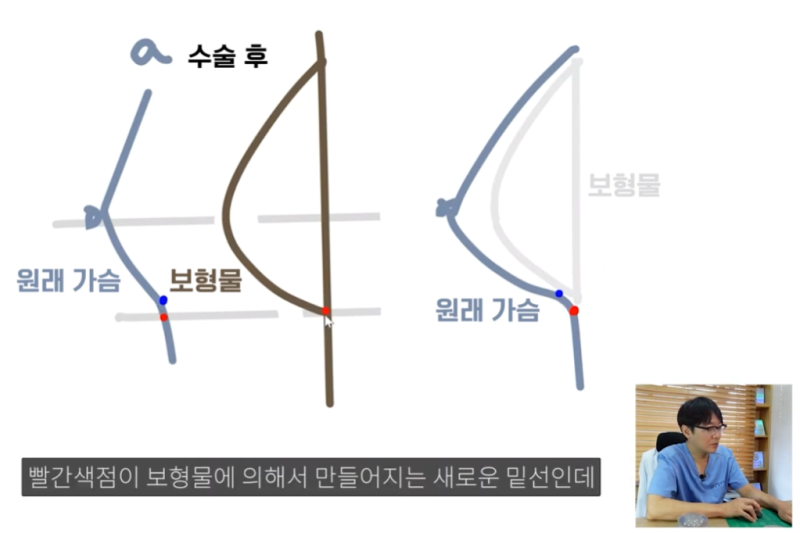 Two Crucial Factors When Deciding on Breast Augmentation with Implants? 사진 6