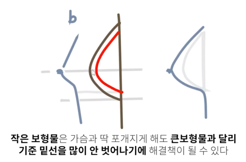 Two Crucial Factors When Deciding on Breast Augmentation with Implants? 사진 7