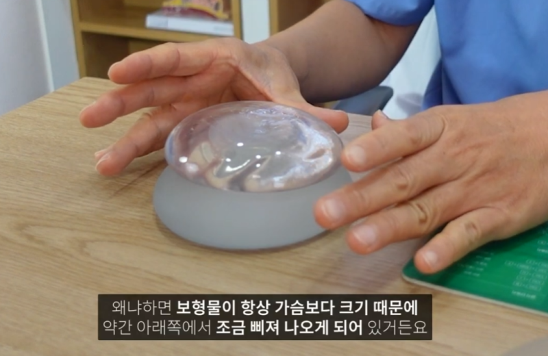 Two Crucial Factors When Deciding on Breast Augmentation with Implants? 사진 5