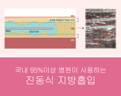 강남 전신지방흡입병원 후기 많은 곳?