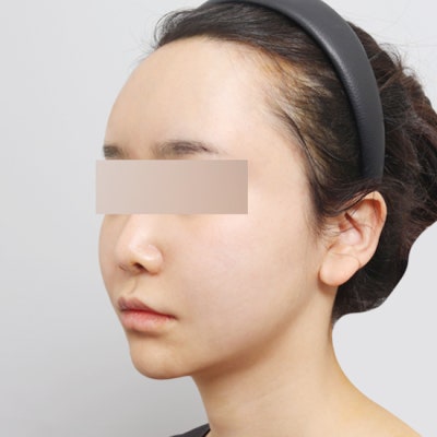 해골상 탈출기! 💀 얼굴지방이식으로 생기 있는 이미지로 사진 2