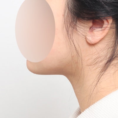 이중턱 지방흡입, 고민 중이시라면 꼭 알아두세요 🙂 사진 8