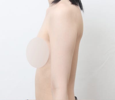 팔 지방흡입, 팔뚝 살이 고민이시라면 알아두세요! 🙂 사진 8