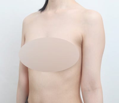 팔 지방흡입, 팔뚝 살이 고민이시라면 알아두세요! 🙂 사진 6