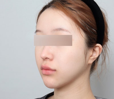 얼굴지방이식, 자연스러운 볼륨을 위한 방법 🌿 사진 4