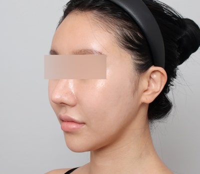 얼굴지방이식, 자연스러운 볼륨을 위한 방법 🌿 사진 2