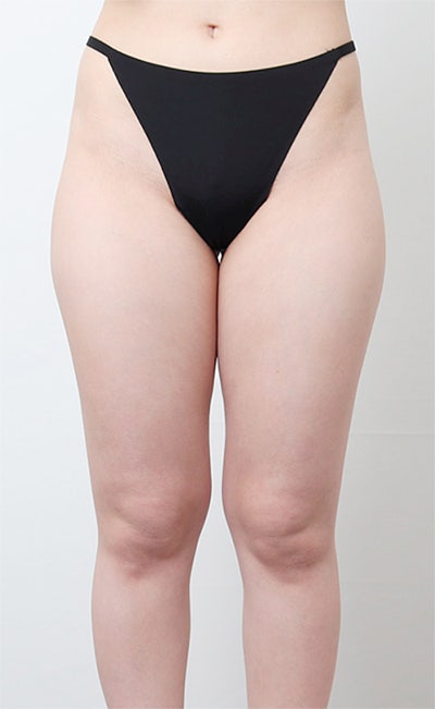 허벅지 지방흡입 3000cc 케이스 (+전후사진)