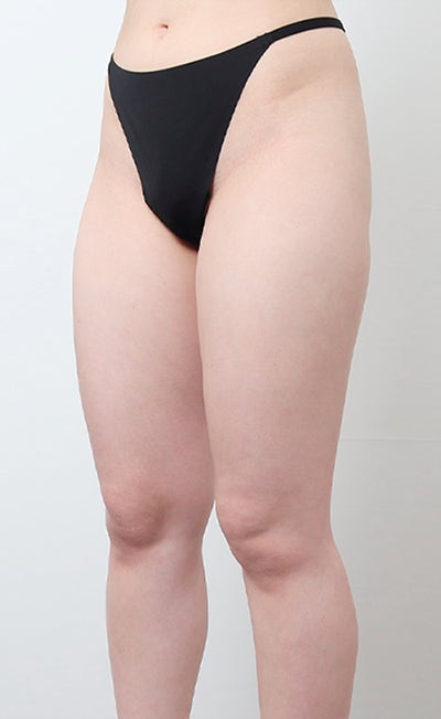허벅지 지방흡입 3000cc 케이스 (+전후사진) 사진 4