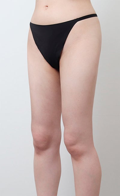 허벅지 지방흡입 3000cc 케이스 (+전후사진) 사진 5