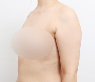 운동으로 안 빠지는 팔뚝살 (+1600cc 지흡 전후)