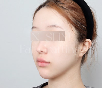 실제 환자 전후로 보는 얼굴 지방이식 변화 사진 12