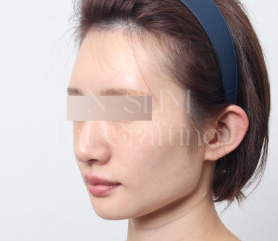 실제 환자 전후로 보는 얼굴 지방이식 변화 사진 9