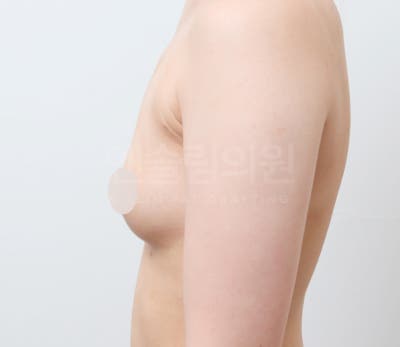 가슴지방이식 자연스럽게 채우기 (+실제사례) 사진 12