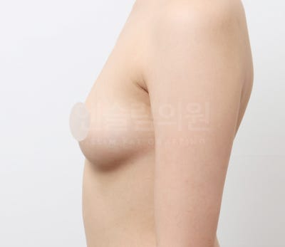 가슴지방이식 자연스럽게 채우기 (+실제사례) 사진 8