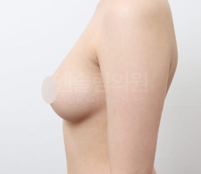 가슴지방이식 자연스럽게 채우기 (+실제사례) 사진 9