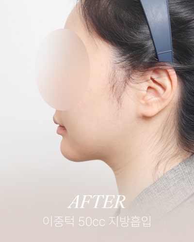부위별 지방흡입, 나에게 맞는 방법 찾기 (+전후) 사진 5